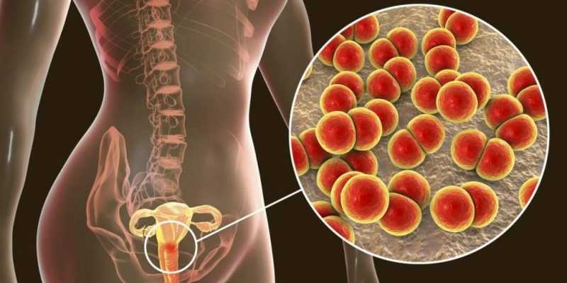 Pelvic Inflammatory Disease (PID): Penyebab, Gejala, dan Cara Mencegahnya