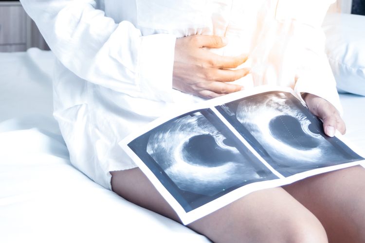 Kista Ovarium, Berikut Penyebab dan Cara Mencegahnya