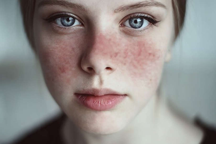 Penyebab Autoimun pada Wanita yang Harus Anda Ketahui