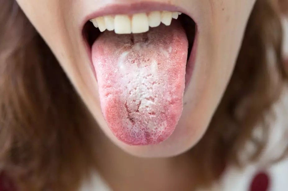 Mengenal Candidiasis Beserta Gejala dan Penyebabnya