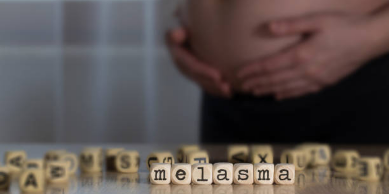 Mengenal Melasma Saat Hamil dan Cara Mengatasinya